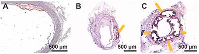 Therapeutic Response of miR-145 Micelles on Patient-Derived Vascular Smooth Muscle Cells